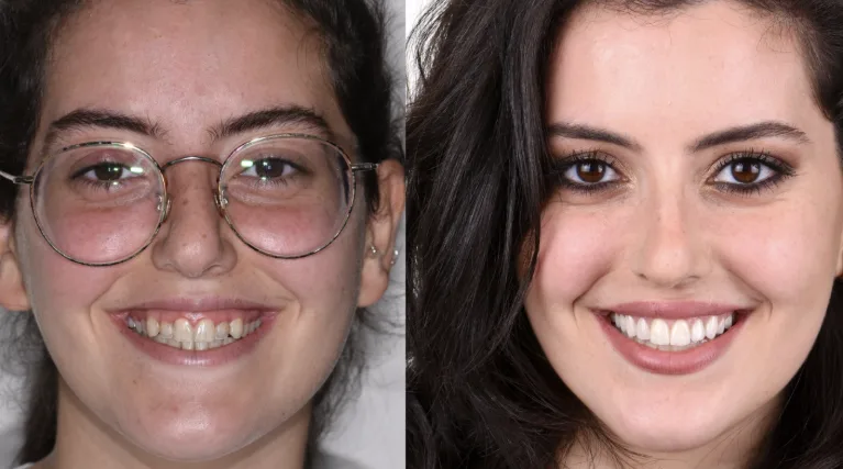 Smile transformation with porcelain veneers - cosmetic dentistry at Mineers Smile Center Beirut