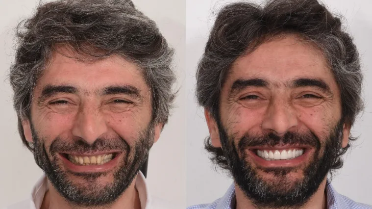 Male smile makeover result - porcelain veneers at Mineers Smile Center Beirut Lebanon