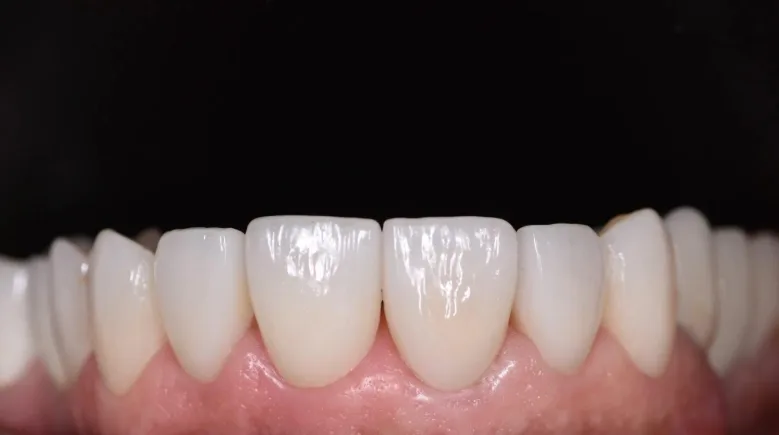 Teeth whitening and veneer results - Dr. Elias Abou Tayeh Mineers Smile Center Beirut