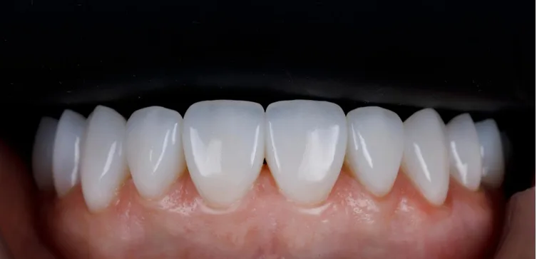 Digital intraoral scan for precision diagnosis - Mineers Smile Center Beirut Lebanon