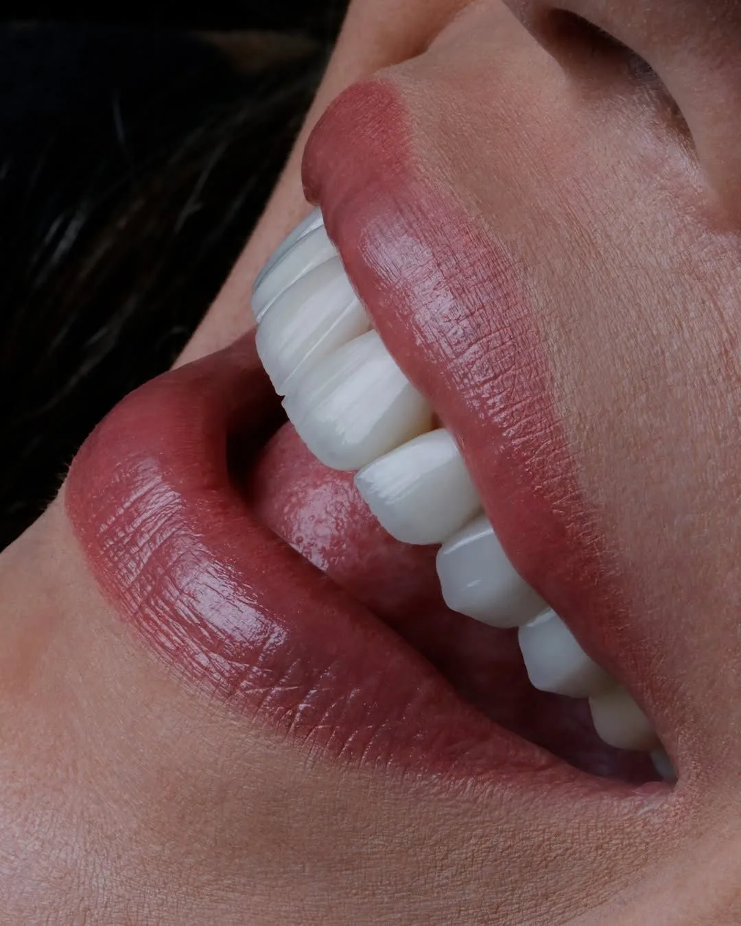 Natural white teeth with digital veneers - cosmetic dentistry at Mineers Smile Center Beirut