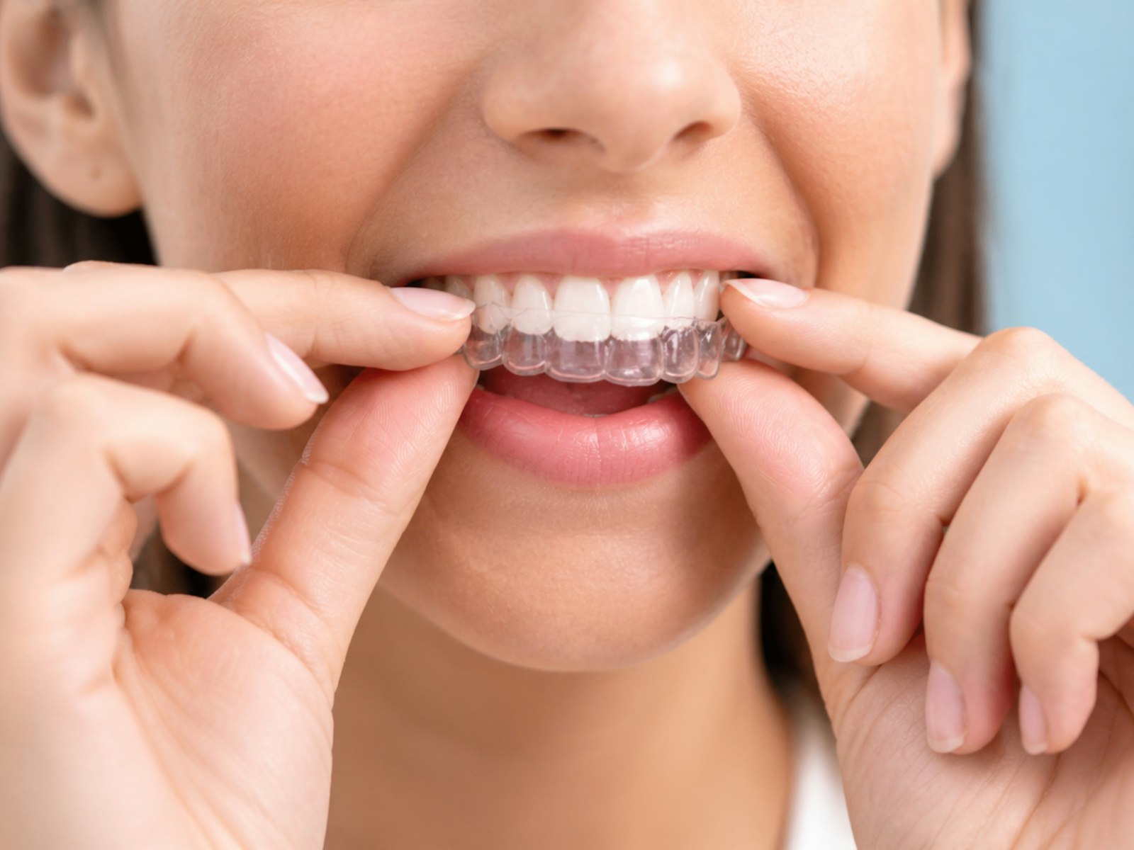 How Long Does Clear Aligner Treatment Take? A Complete Timeline Guide